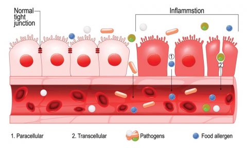 Leaky Gut: What It Is and How to Heal It - Gastro Savannah