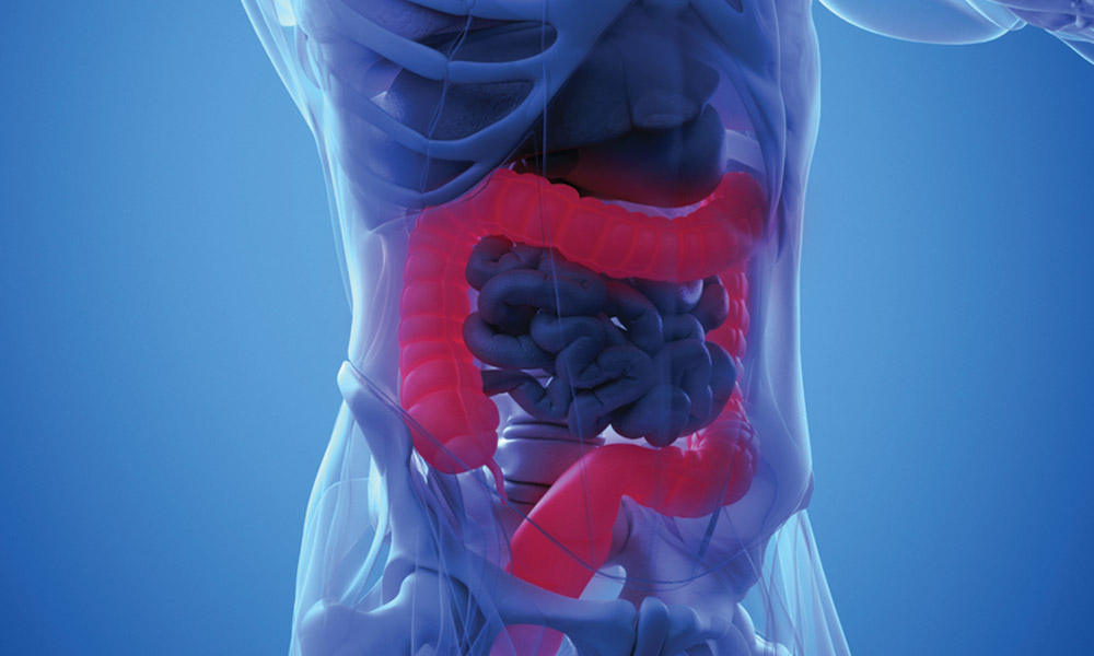Diverticulosis