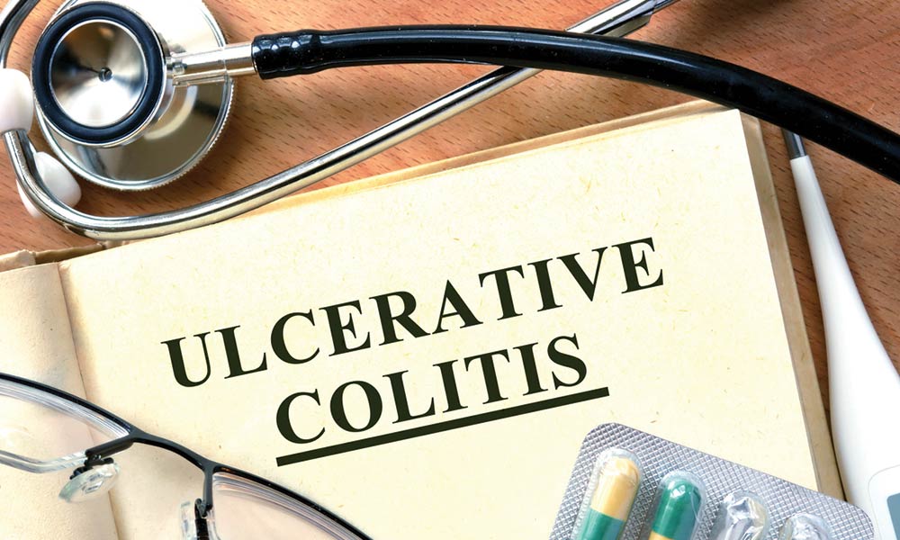 Ulcerative Colitis